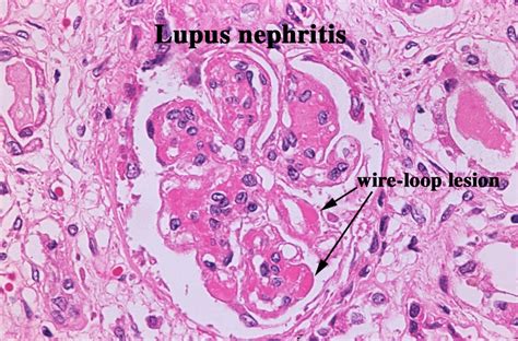 Diffuse Proliferative Glomerulonephritis Wire Looping