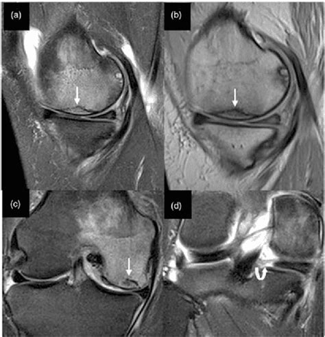 Figure 4 from Subchondral insufficiency fractures of the knee: review of imaging findings ...