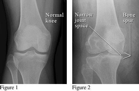 Knee Pain & Osteoarthritis - Amy Chen - Registered Physiotherapist ...