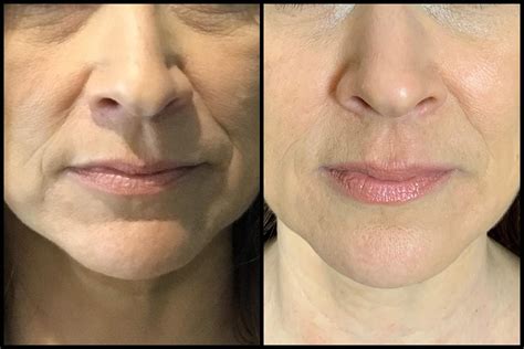 Fillers For Face Before And After Photos - Before After Restylane Injections Dermal Fillers Dr ...