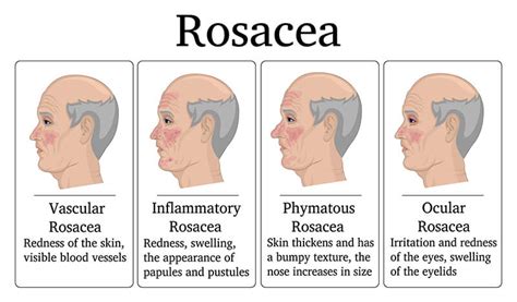 Rosacea: Symptoms, causes, how to treat this chronic skin condition