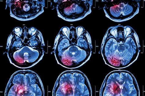 Primary Brain Tumor Types, What to Know, and FAQs