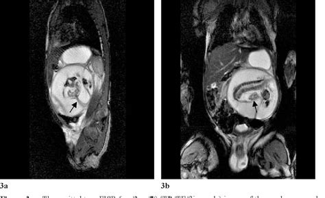 Figure 3 from Fetus-in-fetu: MR a ppearance and a case report ...