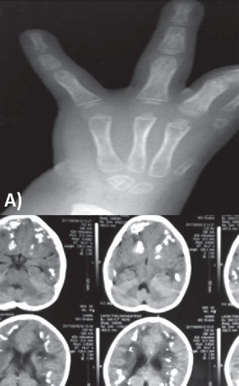 Figure 2 from A Child with Roberts Syndrome: A Case Report | Semantic ...