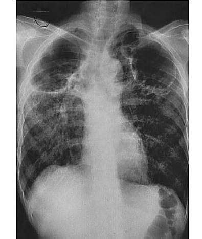 Tuberculosis Chest X Ray Findings