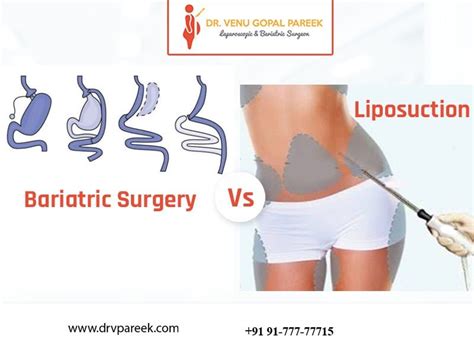 Bariatric Surgery Vs. Liposuction - Bariatric Surgeon India