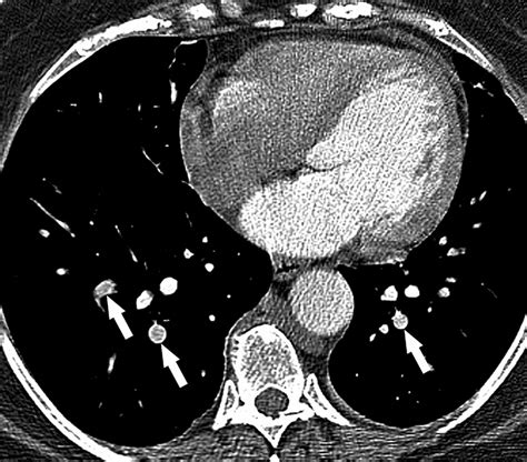 CT Angiography of Pulmonary Embolism: Diagnostic Criteria and Causes of Misdiagnosis | RadioGraphics