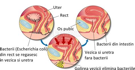 cubo Ubicación Descongelar, descongelar, descongelar heladas ce simptome ai cand ai infectie ...