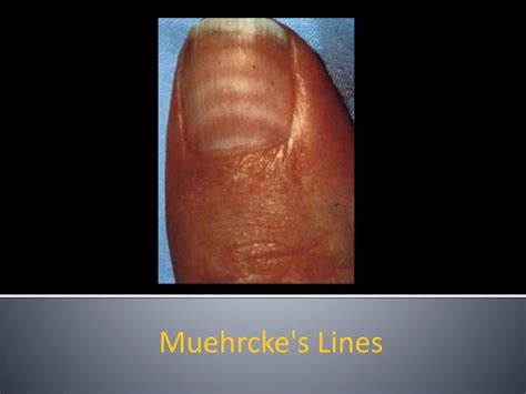 PPT - Nail Disorders: Clues to Systemic Disease PowerPoint Presentation ...