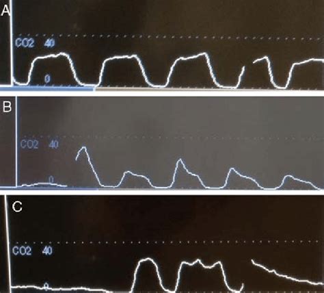 A, A normal capnography wave form of an EtCO 2 resulting from a normal ...