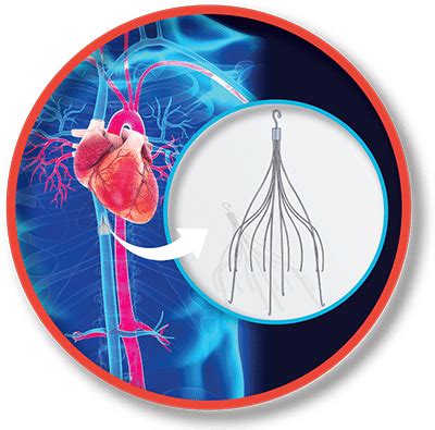 Inferior Vena Cava (IVC) Filter Placement and Removal – New England ...