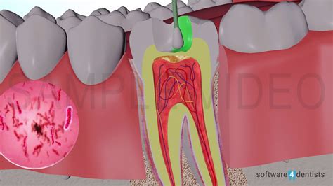 Indirect Pulp capping procedure - YouTube