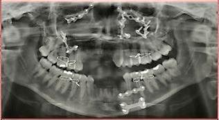 Orthopantomography control postoperatively. Source: Collection of the ...