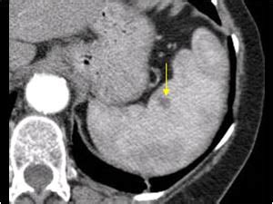 Abdomen and retroperitoneum | 1.4 Spleen : Case 1.4.2 Benign mass lesion of the spleen ...