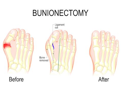 Minimally Invasive Bunion Surgery - Choose the new Technique!