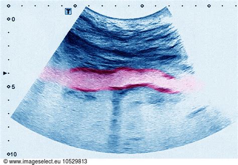 Atheromatous aorta Atheromatous aorta, sonography,examination medical examination result ...