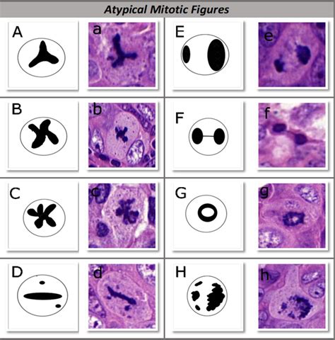 Assessment of mitotic activity in breast cancer: revisited in the digital pathology era ...