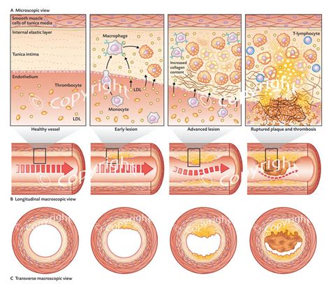 Atherosclerosis - Biology A level