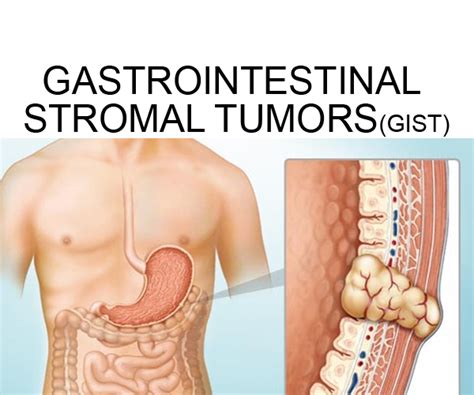 Gastrointestinal Stromal Tumors (GIST) – South Florida Sugical Oncology