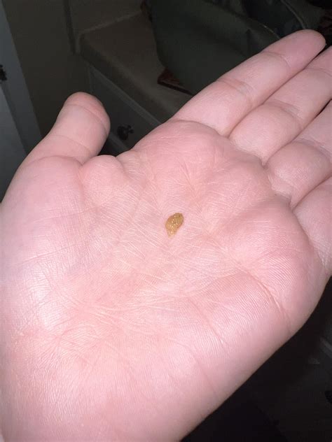 passed my 7mm kidney stone! : r/KidneyStones