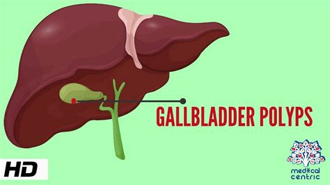 Gallbladder Polyps Symptoms Causes And Treatments Artofit | The Best Porn Website