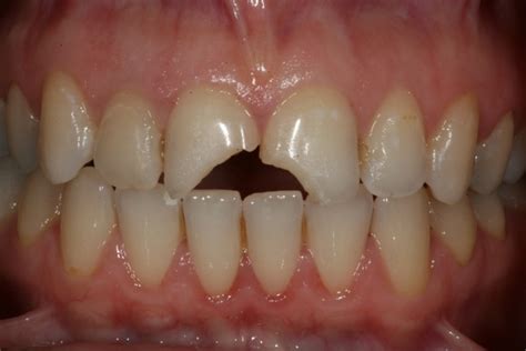 Avoid Cutting the Cingulum from Anterior Teeth | CDOCS