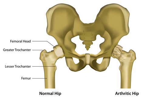 What is the Acetabulum? (with pictures)