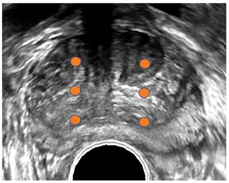 Use of MRI-ultrasound Fusion to Achieve Targeted Prostate Biopsy