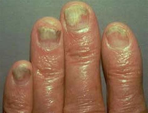 nail psoriasis treatment - pictures, photos