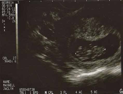 Jaclyn's Jabberings: Ultrasound #2 and Week 10