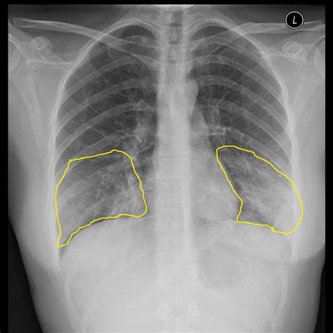 Q fever differential diagnosis - wikidoc