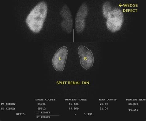 Renal scintigraphy Archives - Renal Fellow Network