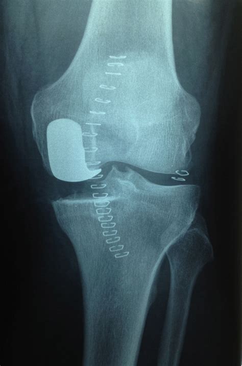 Knee — Hemiarthroplasty - Avalon Orthopaedic