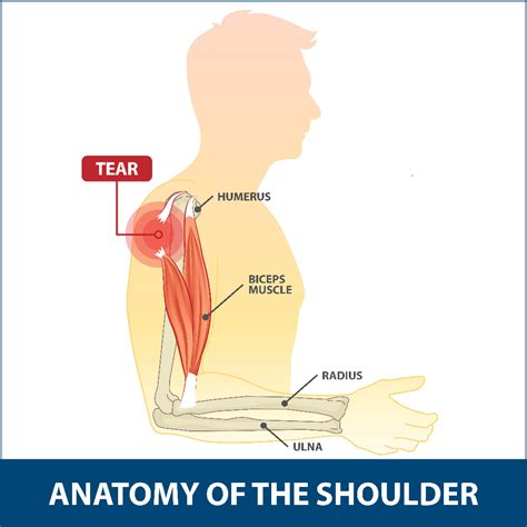 Bicep Tendon Tear Info | Florida ... Muscle Tear, Muscle Pain, Tendon Tear, Upper Arm Bone ...