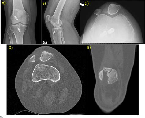 Figure 1 from Management of Patella Fracture Nonunion and Large Bone Defect After Bone–Patellar ...