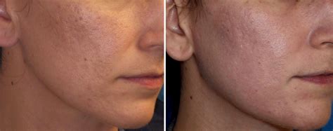 Laser Treatment of Acne Scars