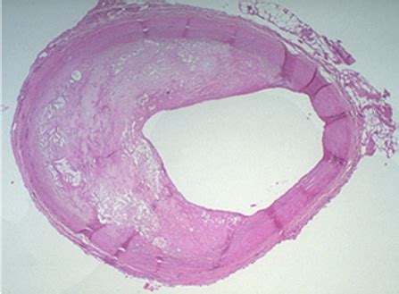 Pathogenesis of Atherosclerosis