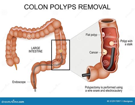 Colon Polyps Removal. Colonoscopy And Polypectomy Cartoon Vector | CartoonDealer.com #312917097