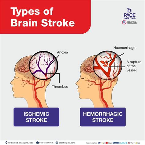 Brain Stroke: Types, Causes, Symptoms, Prevention and Treatment