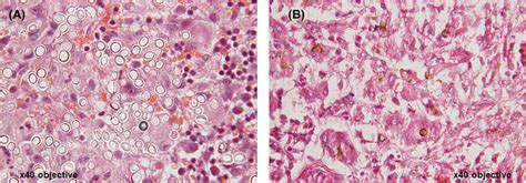 Histology images for fungal infections: (A) African histoplasmosis;... | Download Scientific Diagram