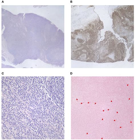 Frontiers | Evaluation of Lymphoproliferative Disease and Increased Risk of Lymphoma in ...