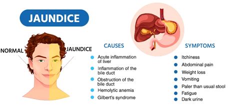 Jaundice: Symptoms, Causes, Do’s and Don'ts, Treatment | Medicover