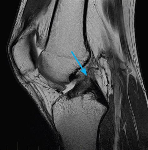 mri-knee-acl-tear - MRI at Melbourne Radiology Clinic