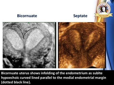 3D-4D ULTRASOUND IN UTERINE SEPTUM EVALUATION