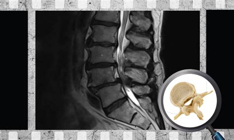 Relationship Between MRI Findings and Clinical Symptoms in Lumbar ...