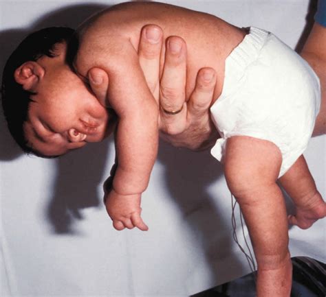 Floppy baby syndrome causes, signs, symptoms, diagnosis & treatment