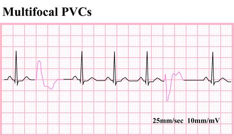 ECG Educator Blog : Ventricular Ectopics