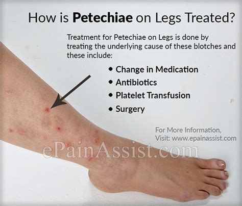 How is Petechiae on Legs Treated? | Legs, Platelets, Treats