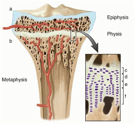 Excision of Physeal Bar | Musculoskeletal Key