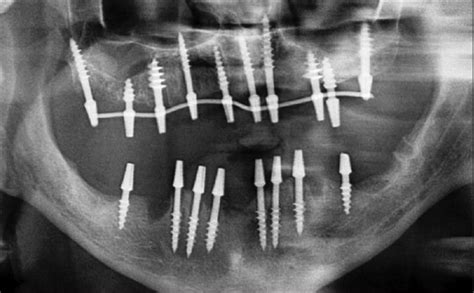 Basal Implant vs Conventional Implant - Everything You Need to Know